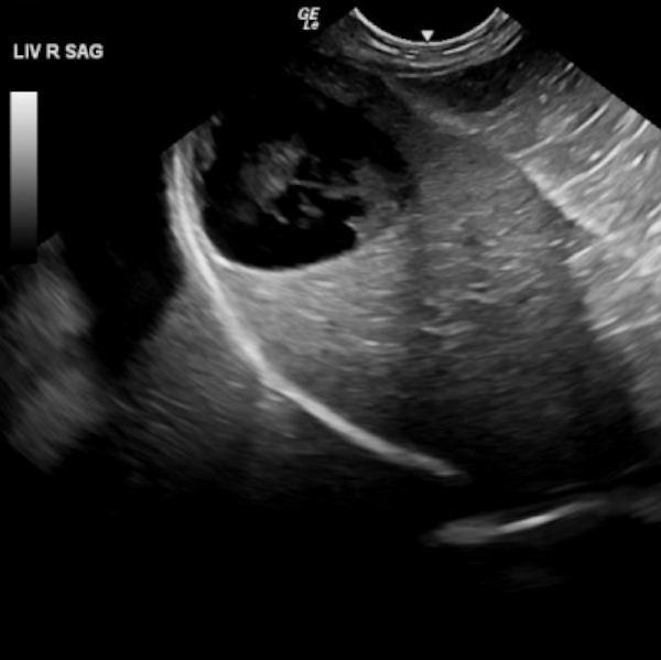 Image of Ultrasound of Liver 